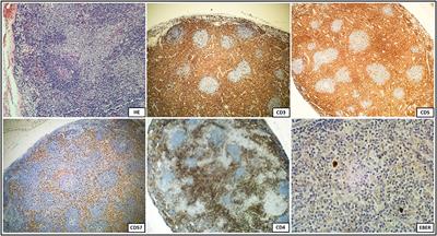 Case Report: Autoimmune Lymphoproliferative Syndrome vs. Chronic Active Epstein-Barr Virus Infection in Children: A Diagnostic Challenge